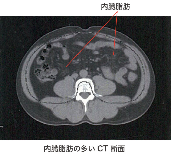 内臓脂肪イラスト