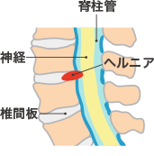 腰椎椎間板ヘルニア