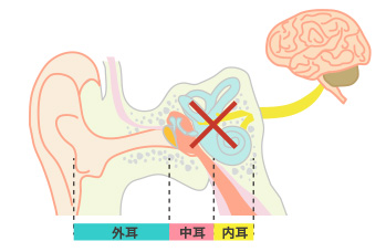 内耳の病気によるめまい