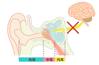 前庭神経の病気によるめまい