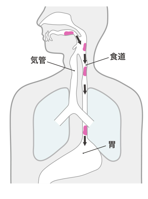 嚥下障害図1